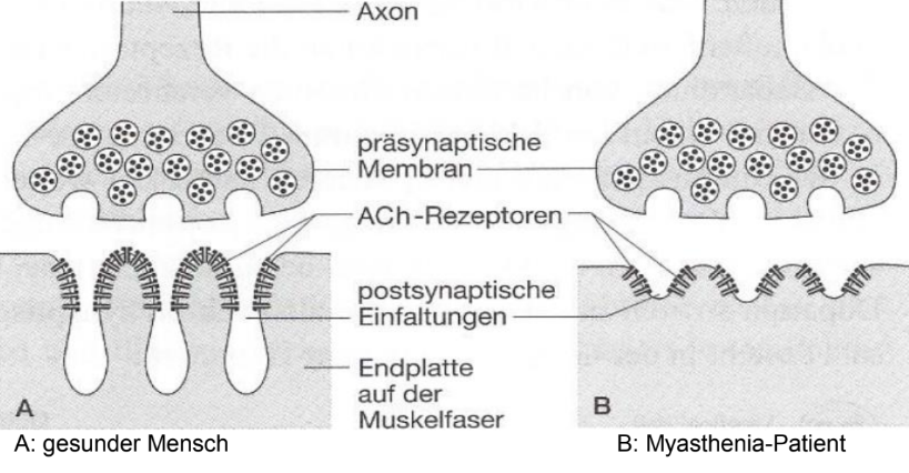 Schematische Darstellung der motorischen Endplatte: links gesund, rechts Myasthenia mit flacheren Falten und weniger ACh‑Rezeptoren